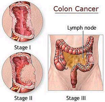 colon cancer